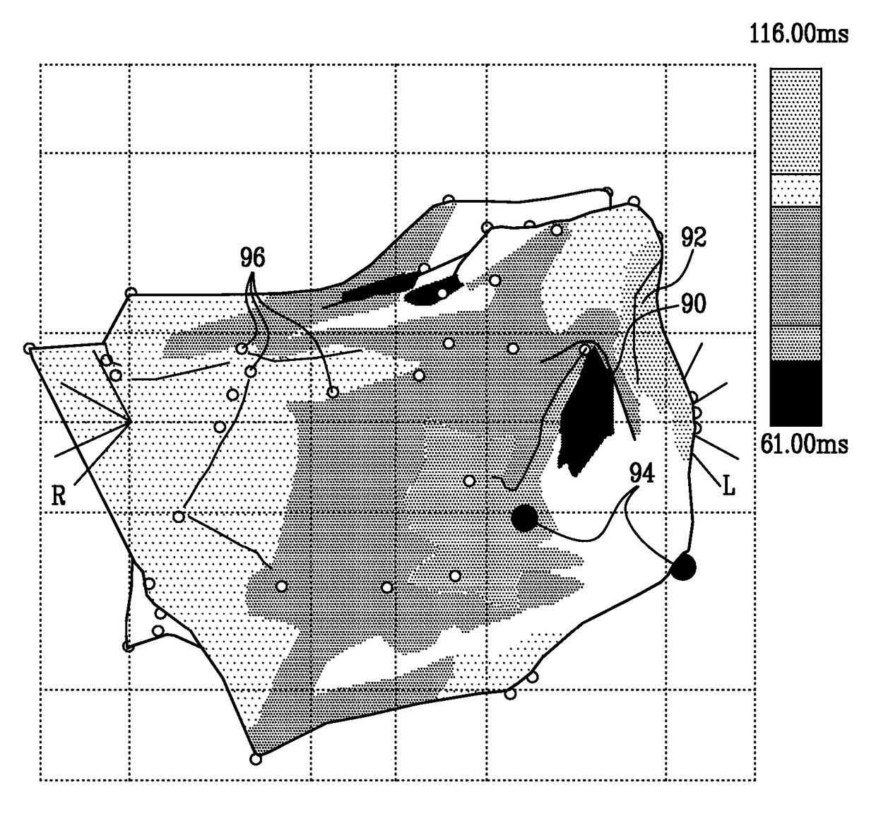 Mapping of complex fractionated atrial electrogram