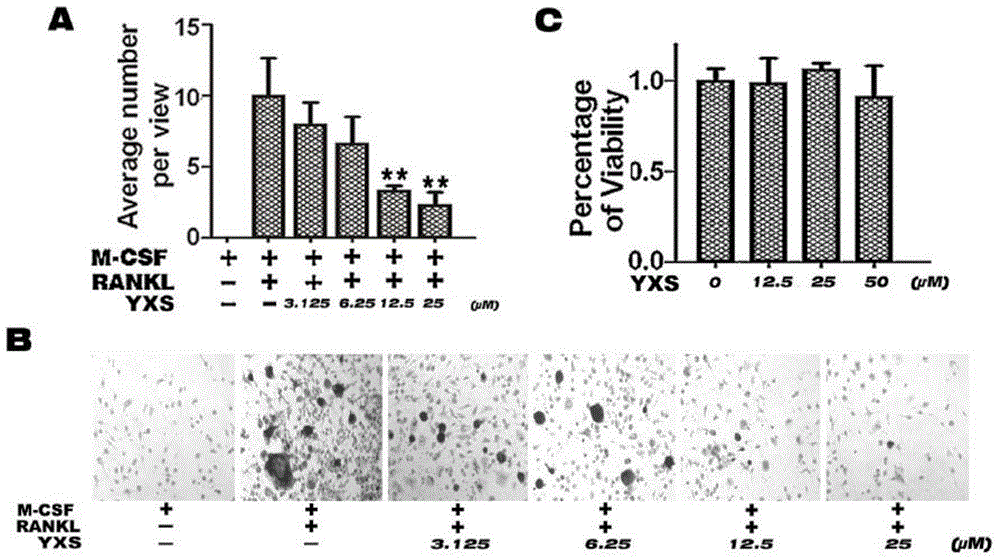 Application of ginkgolic acid in preparation of medicine for preventing and/or treating diseases caused by overactivity of osteoclast