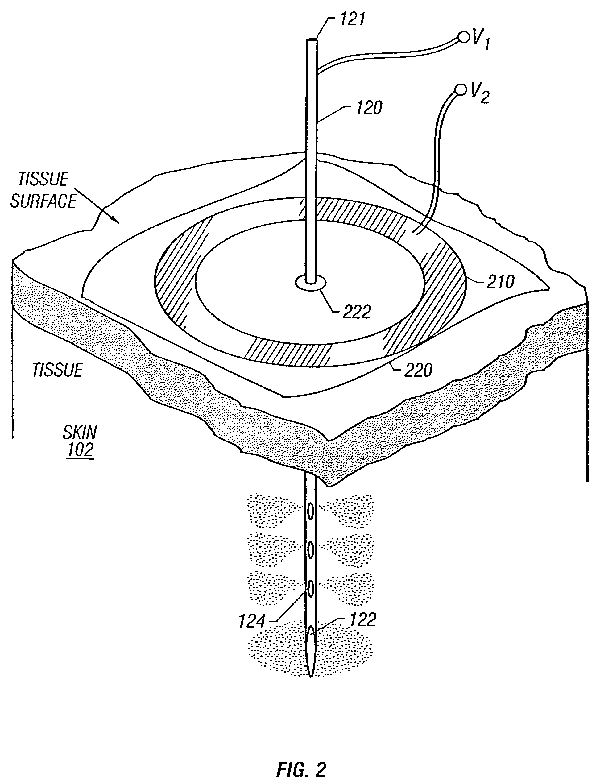 Electrical field therapy with reduced histopathological change in muscle