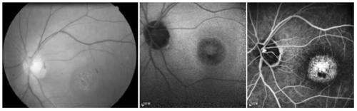 A pathogenic mutation of hereditary central halo retinopathy and its detection reagent