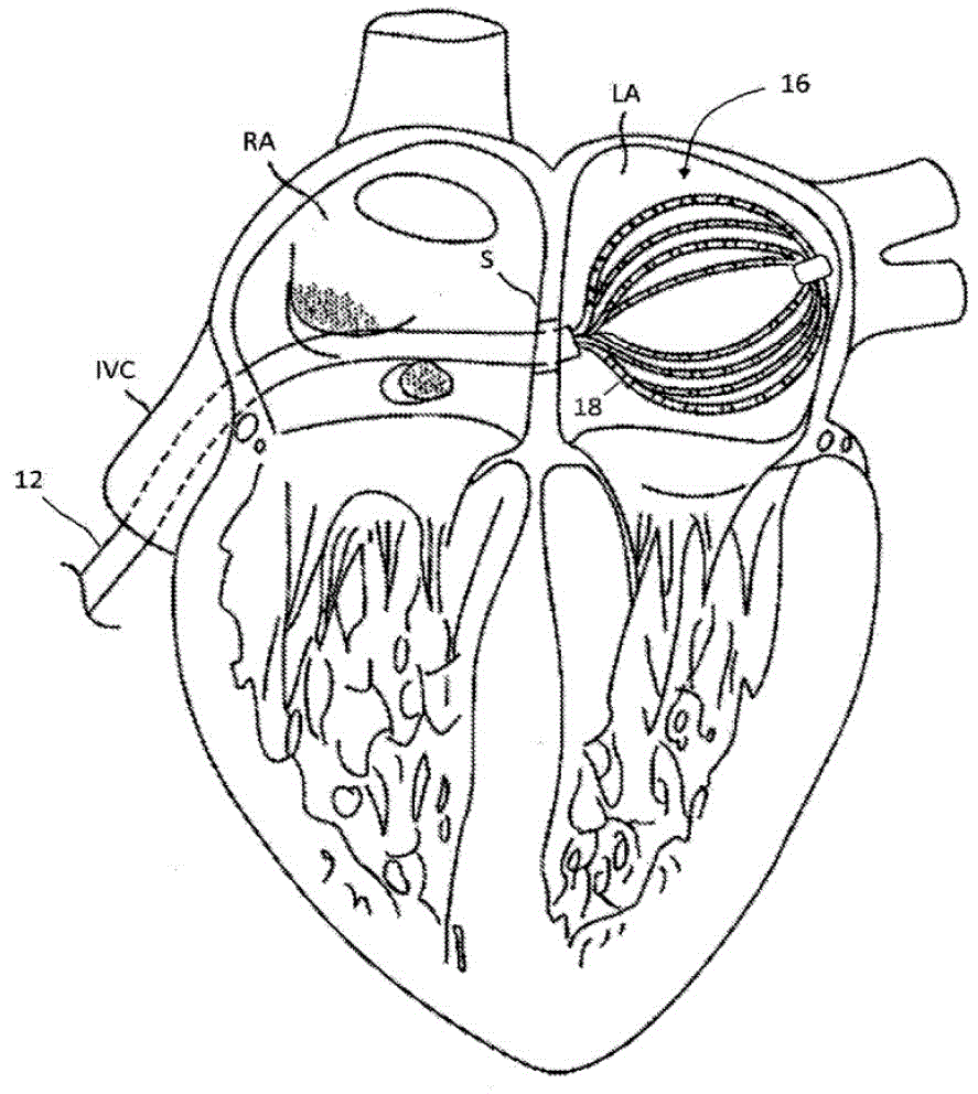 Basket catheter with individual spine control