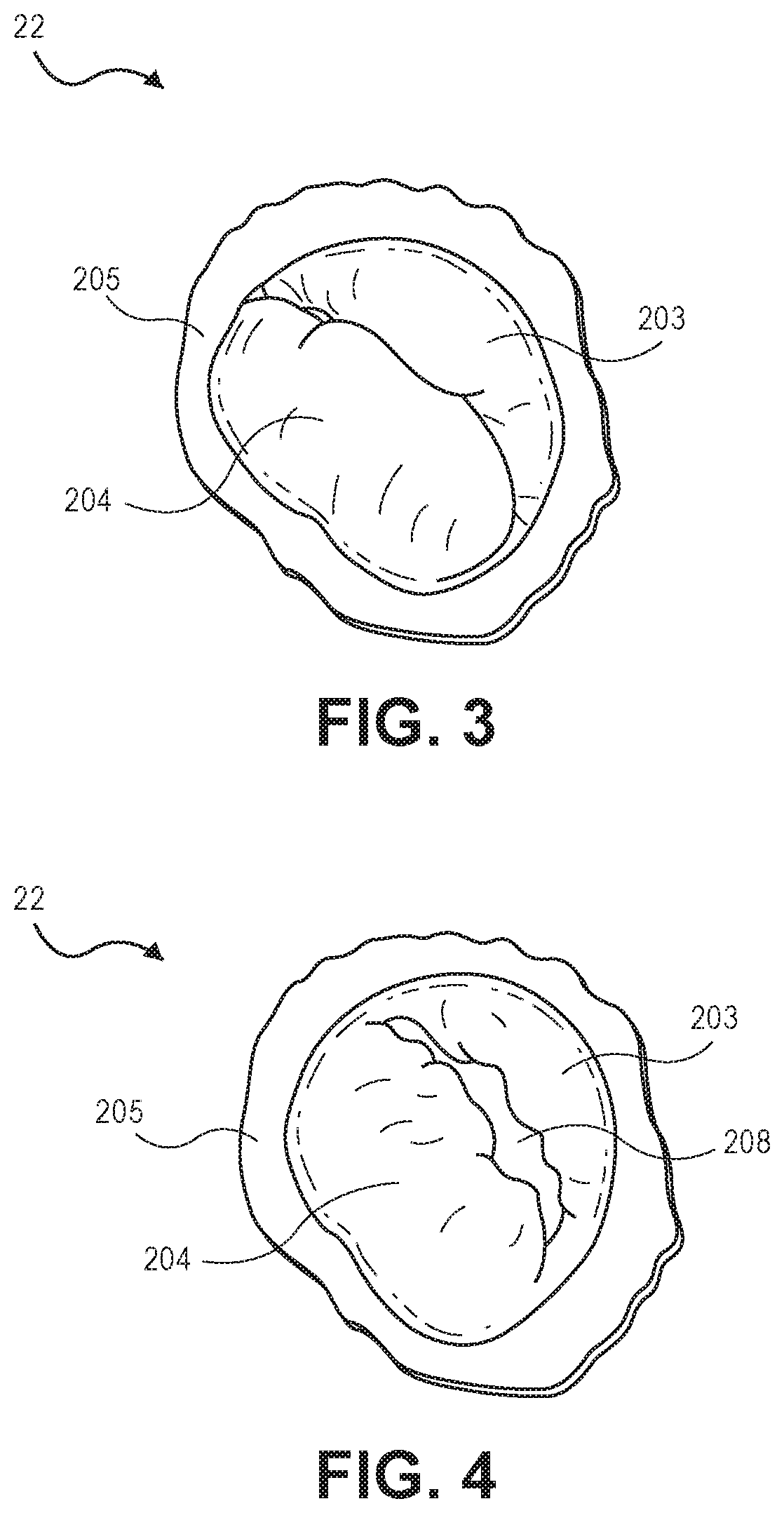 Beating-heart mitral valve chordae replacement