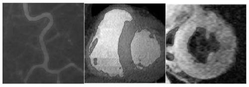 Intracranial hemorrhage area three-dimensional segmentation method based on local entropy and level set algorithm