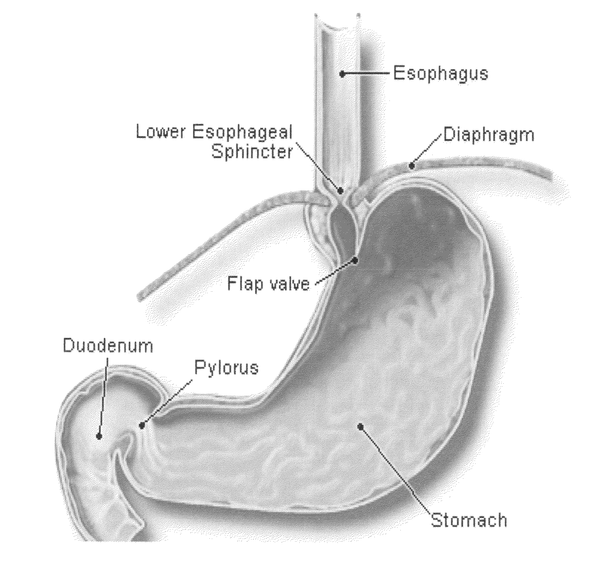 Orally ingestable medicament and method for treating a heartburn inducing event or an acid reflux episode in a living human subject