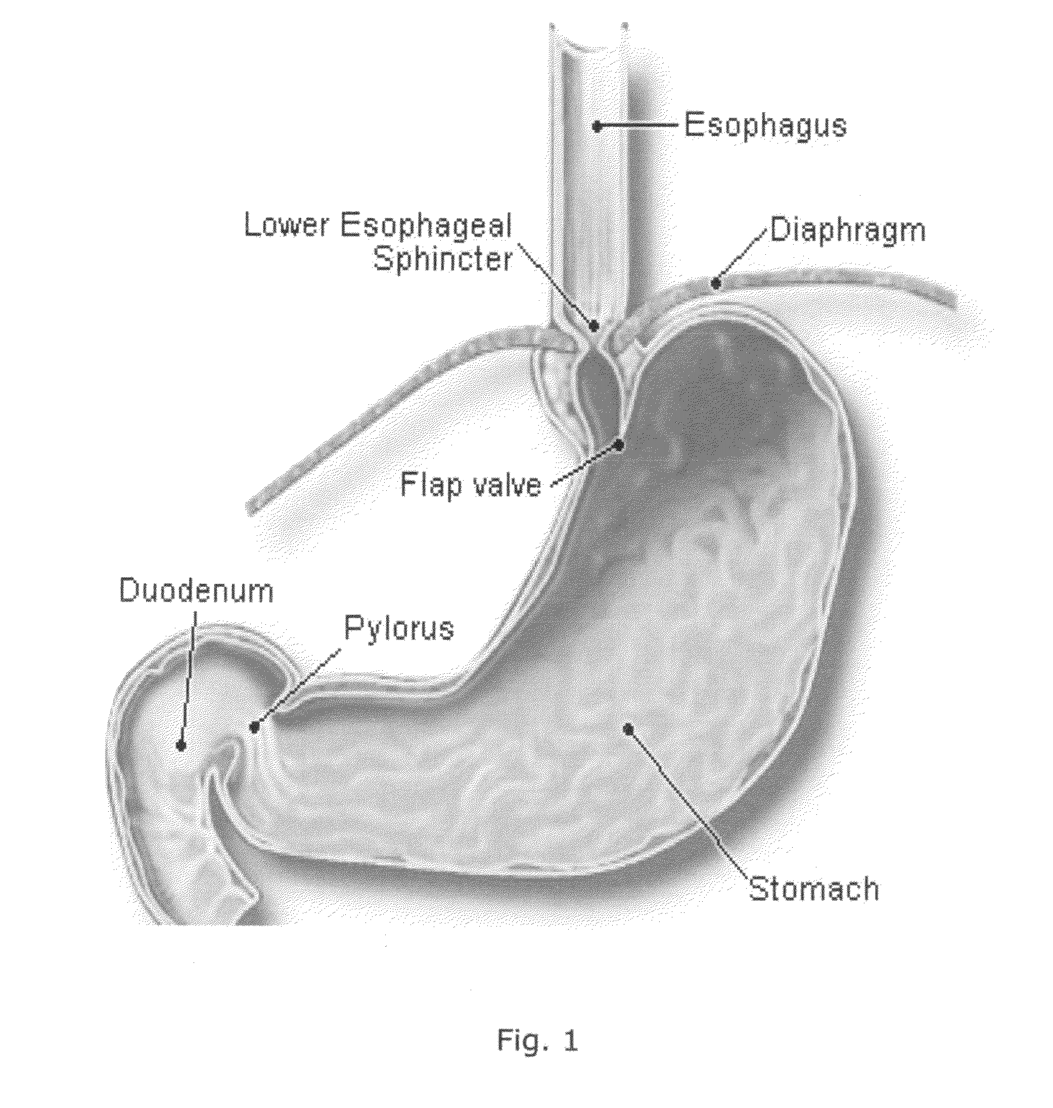 Orally ingestable medicament and method for treating a heartburn inducing event or an acid reflux episode in a living human subject