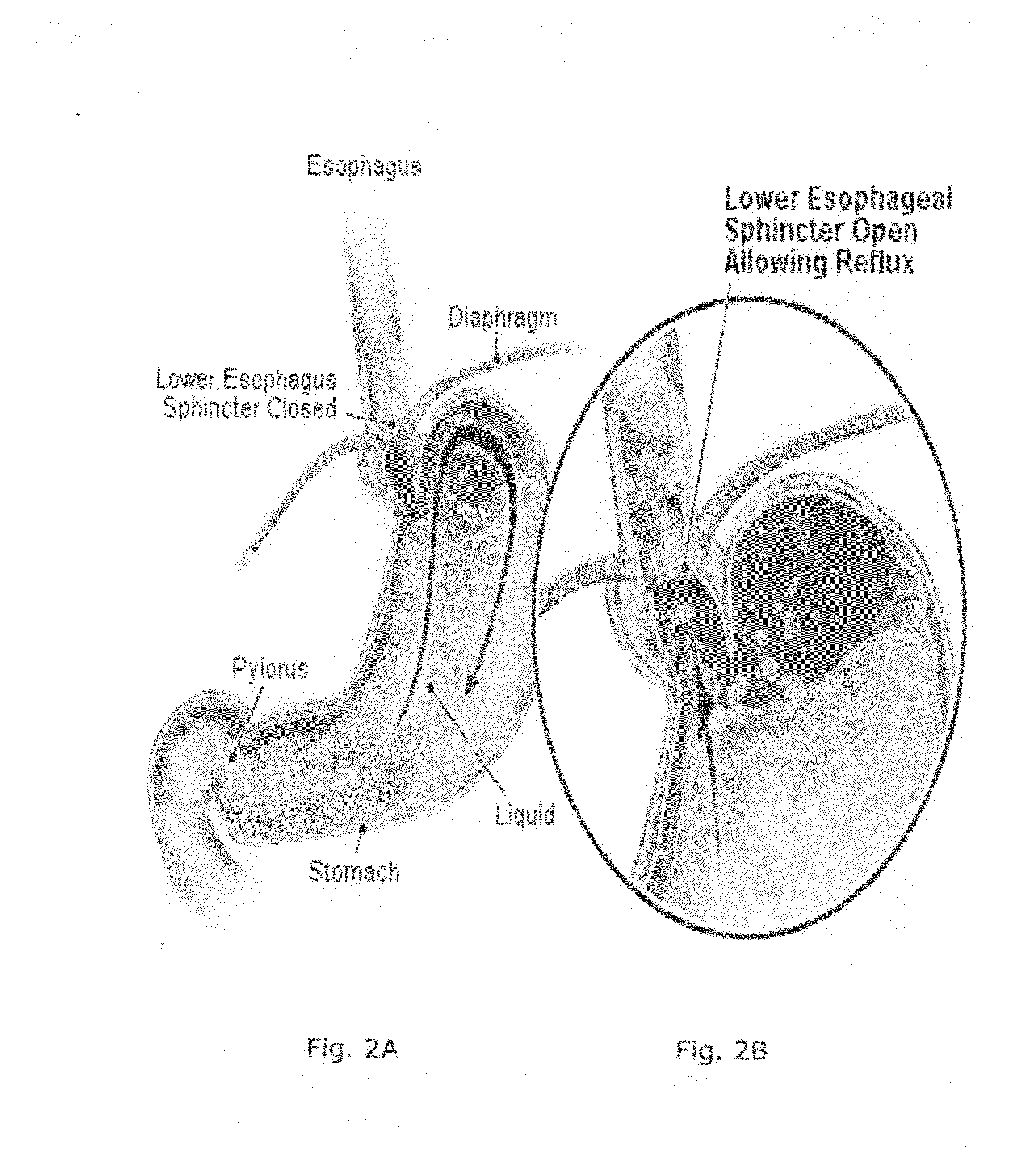 Orally ingestable medicament and method for treating a heartburn inducing event or an acid reflux episode in a living human subject