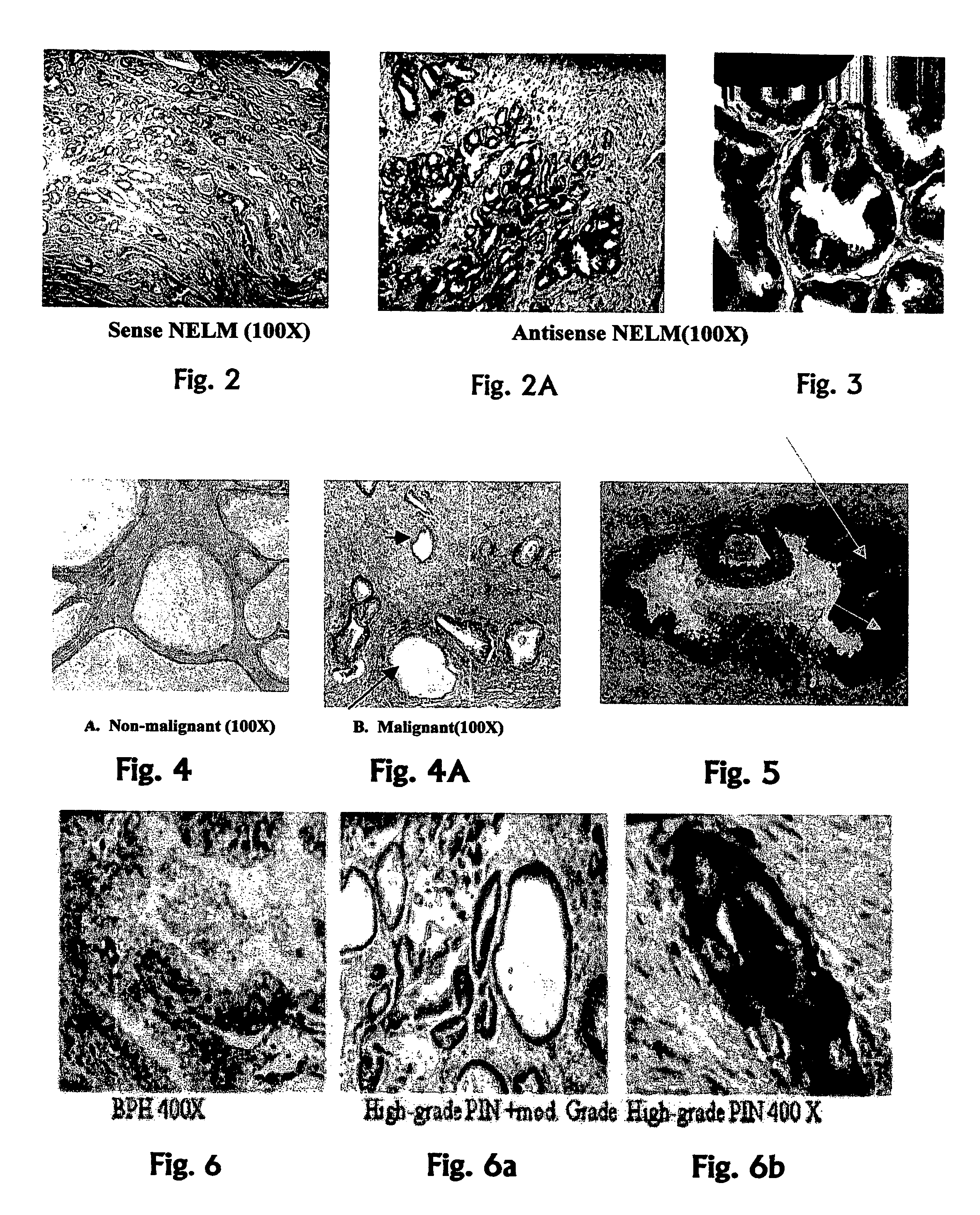 Human cancer cell specific gene transcript