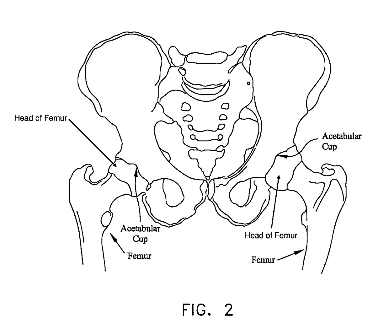 Method and apparatus for treating a joint, including the treatment of cam-type femoroacetabular impingement in a hip joint and pincer-type femoroacetabular impingement in a hip joint