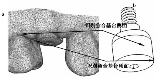 Implant denture individual abutment design method based on healing abutment dental model