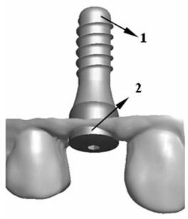 Implant denture individual abutment design method based on healing abutment dental model