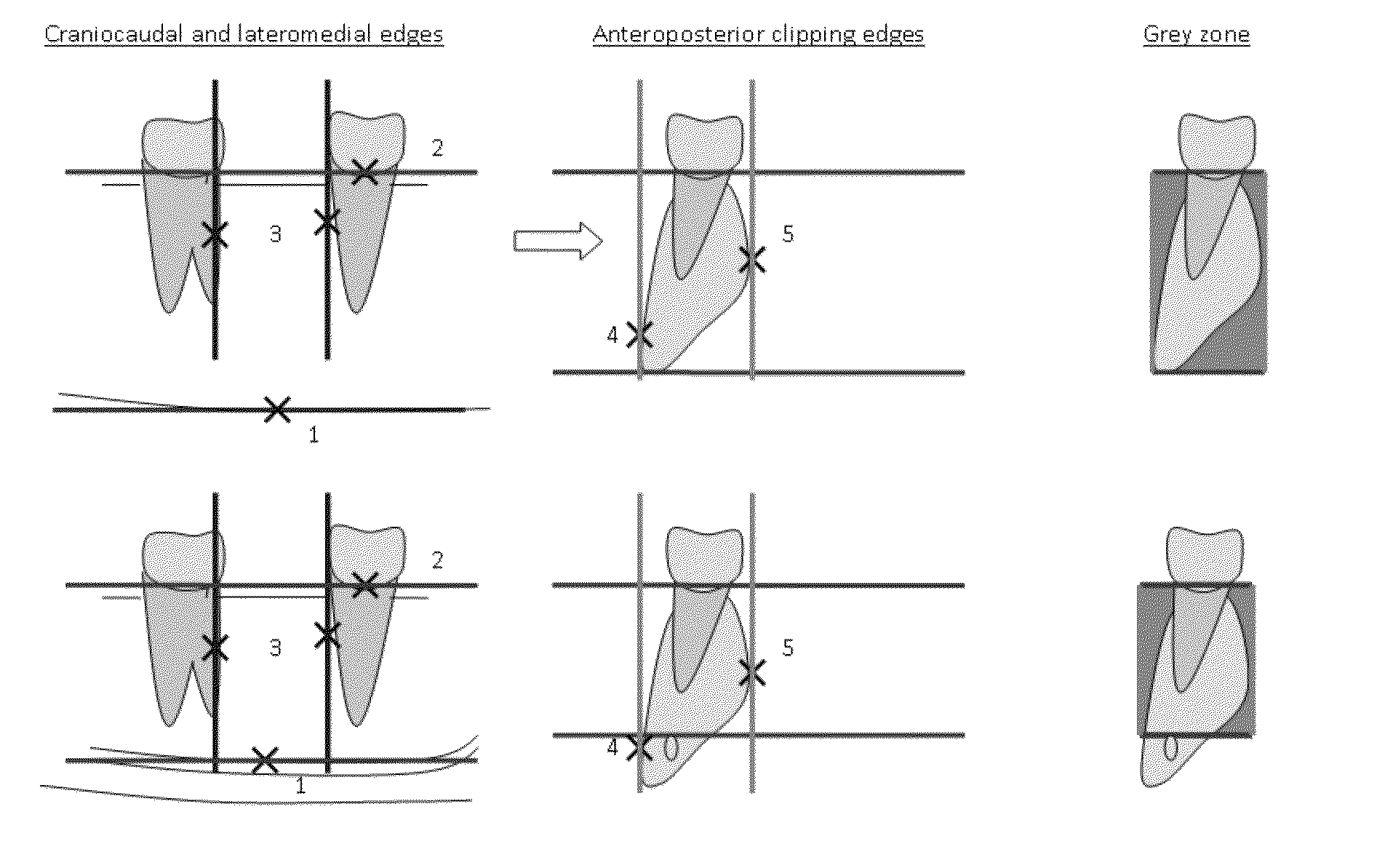 Method for quantifying local bone changes