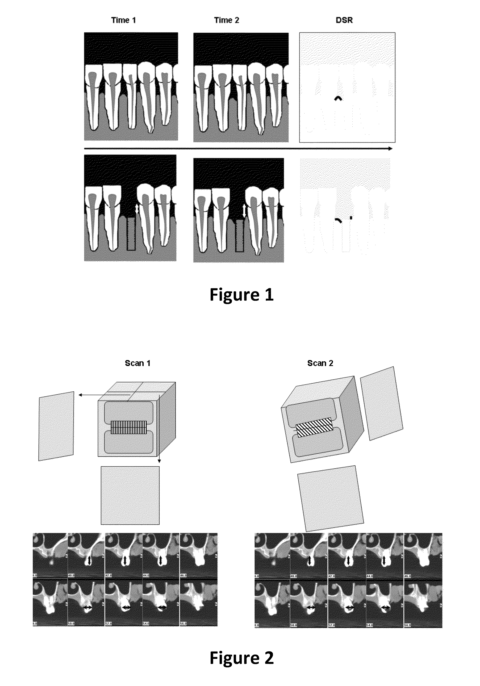 Method for quantifying local bone changes