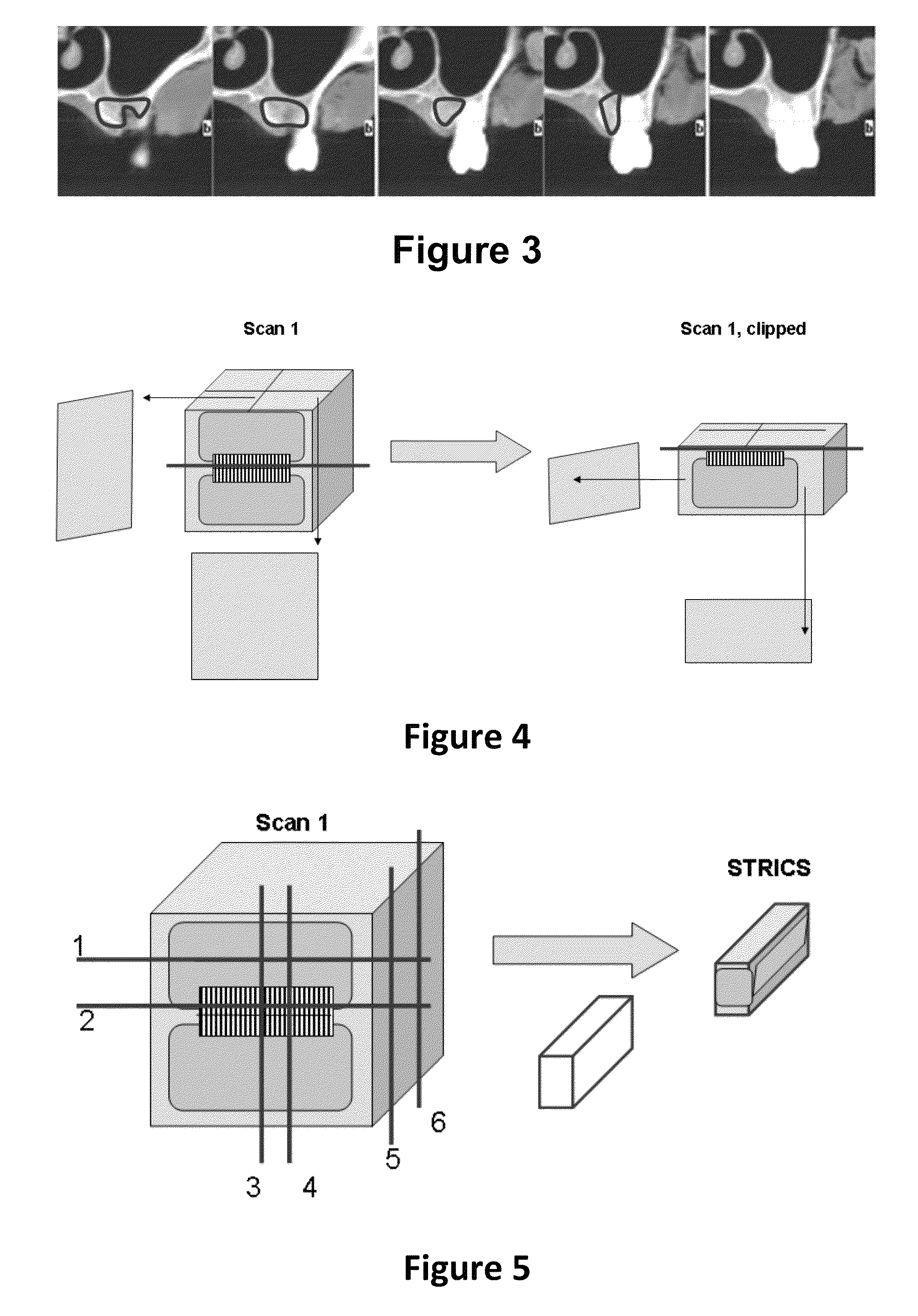 Method for quantifying local bone changes