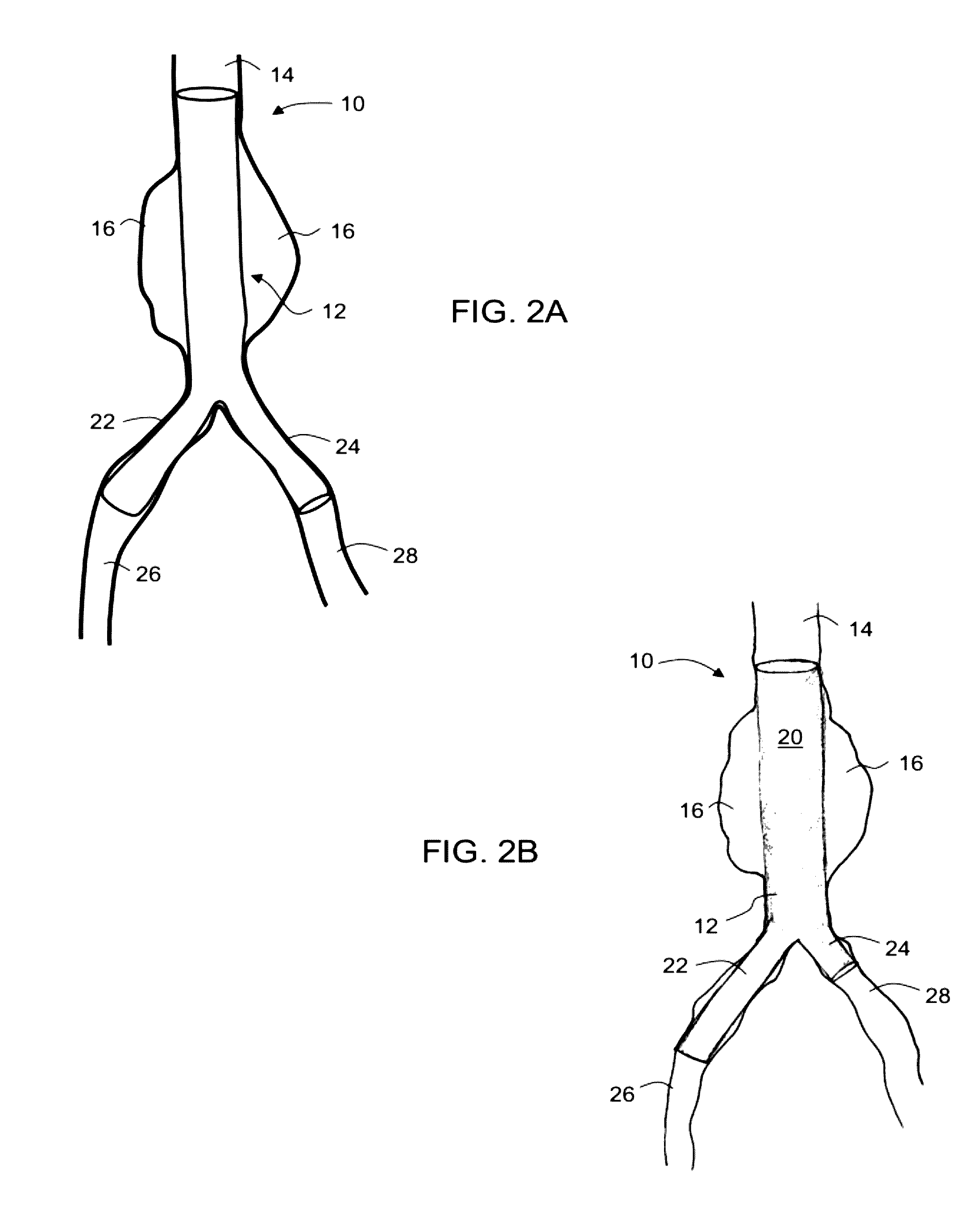 Intraluminal polymeric devices for the treatment of aneurysms