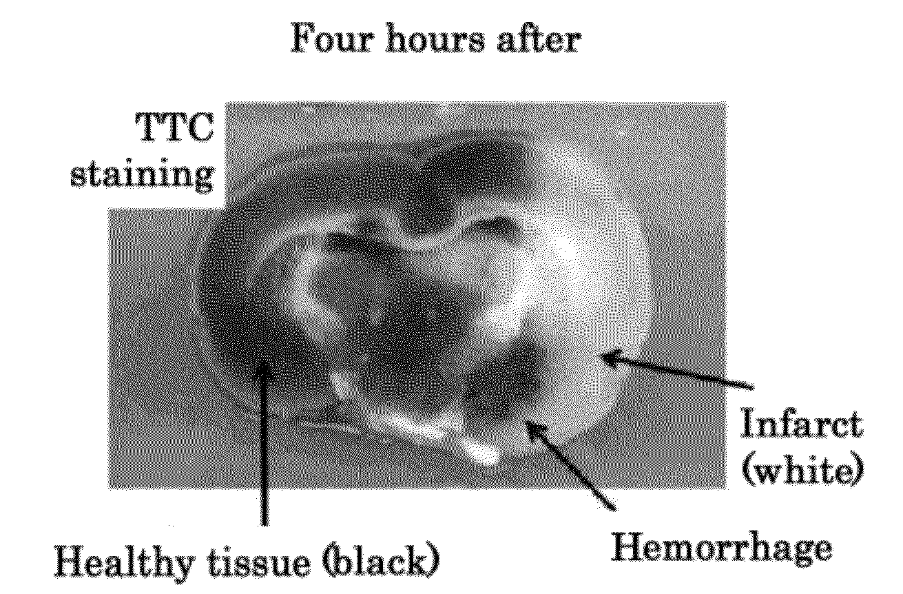 Pharmaceutical composition for treating ischemic events