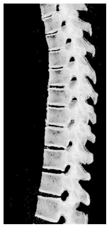 Automatic Cobb angle measurement method based on spine layered reconstruction