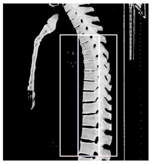 Automatic Cobb angle measurement method based on spine layered reconstruction