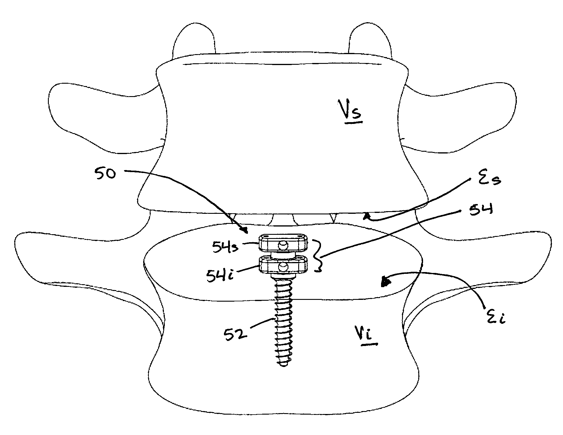 Insert for nucleus implant