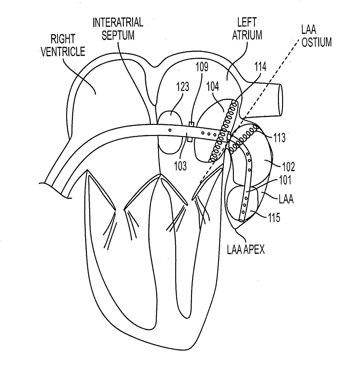 Methods and systems for accessing a pericardial space and preventing strokes arising from the left atrial appendage