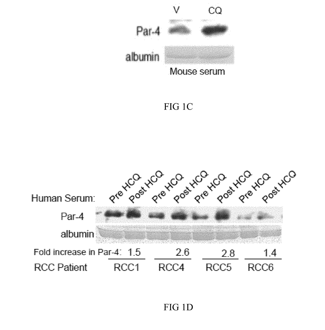 Chloroquine Induction of Par-4 and Treatment of Cancer