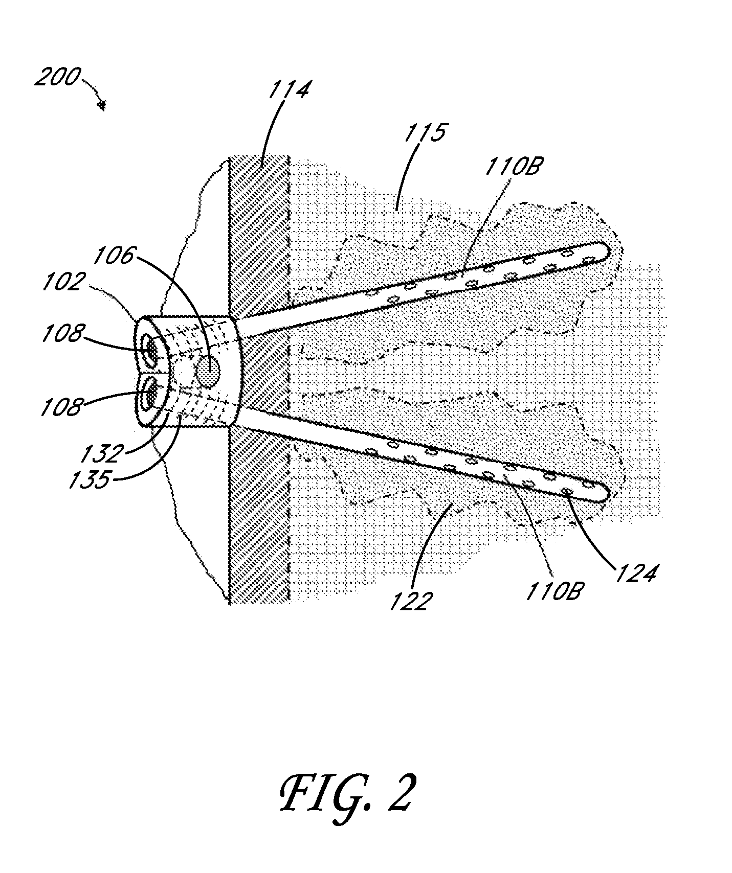 Bone anchor apparatus and method