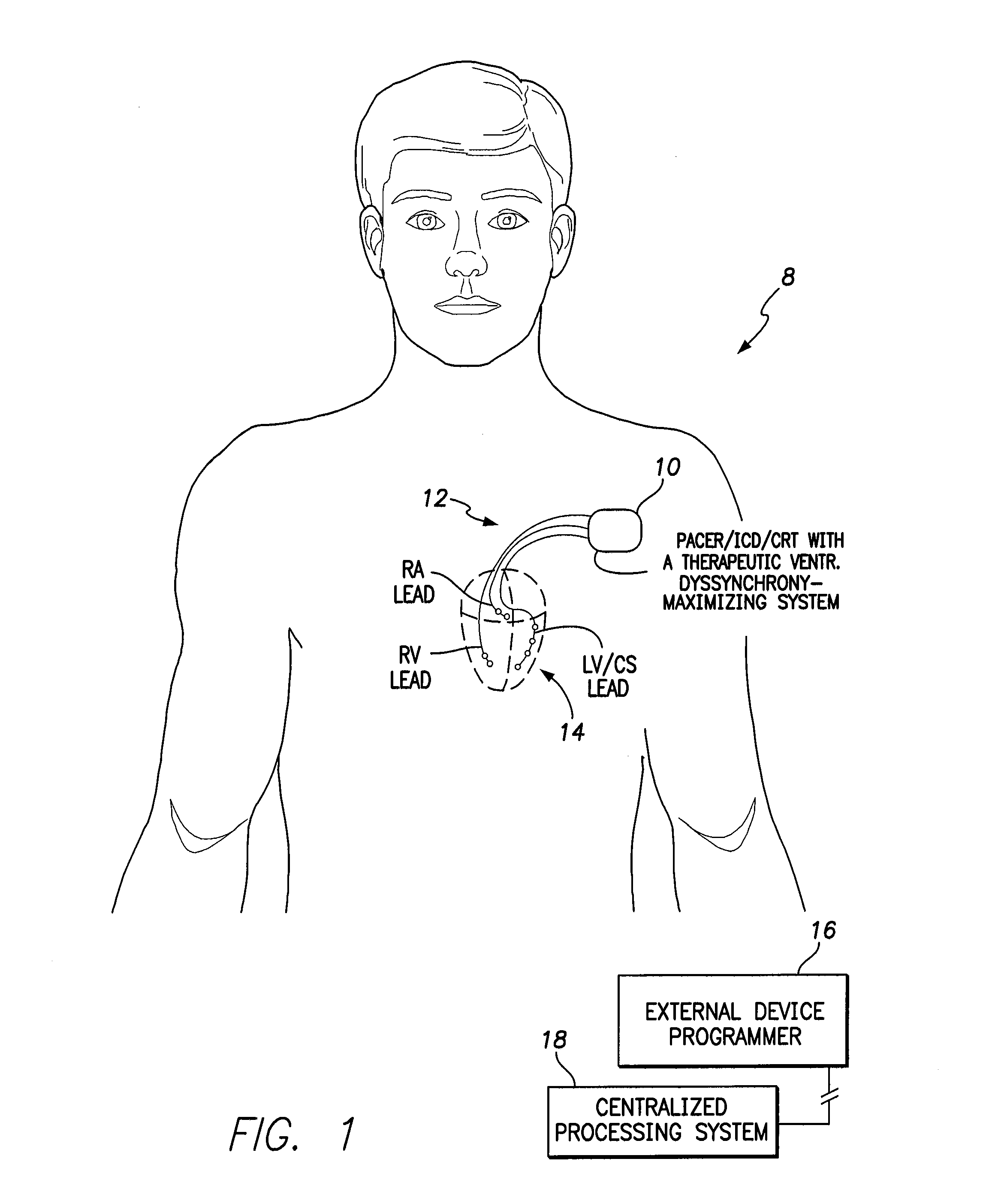 Systems and methods for controlling pacing induced dyssynchrony to reduce ischemic injury using an implantable medical device