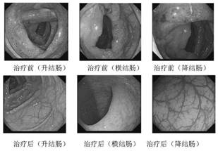 A traditional Chinese medicine composition for rapidly alleviating inflammatory activity of ulcerative colitis and its application