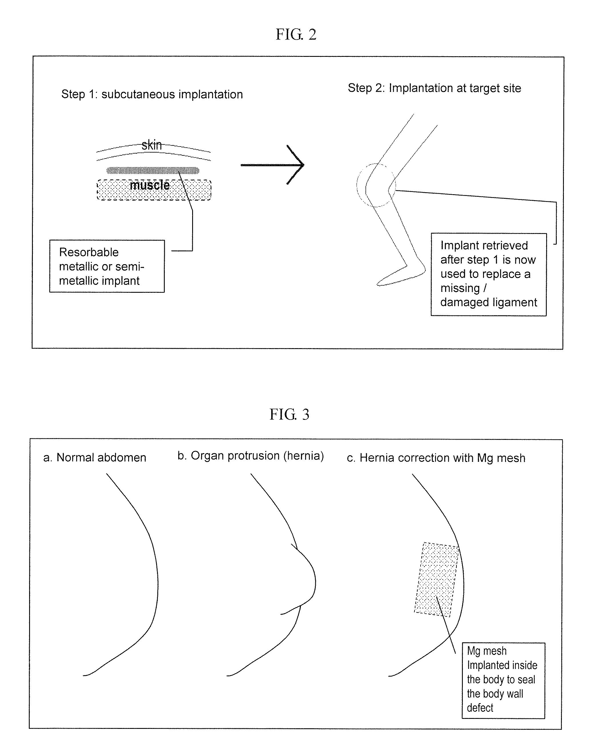 Implant for tissue engineering