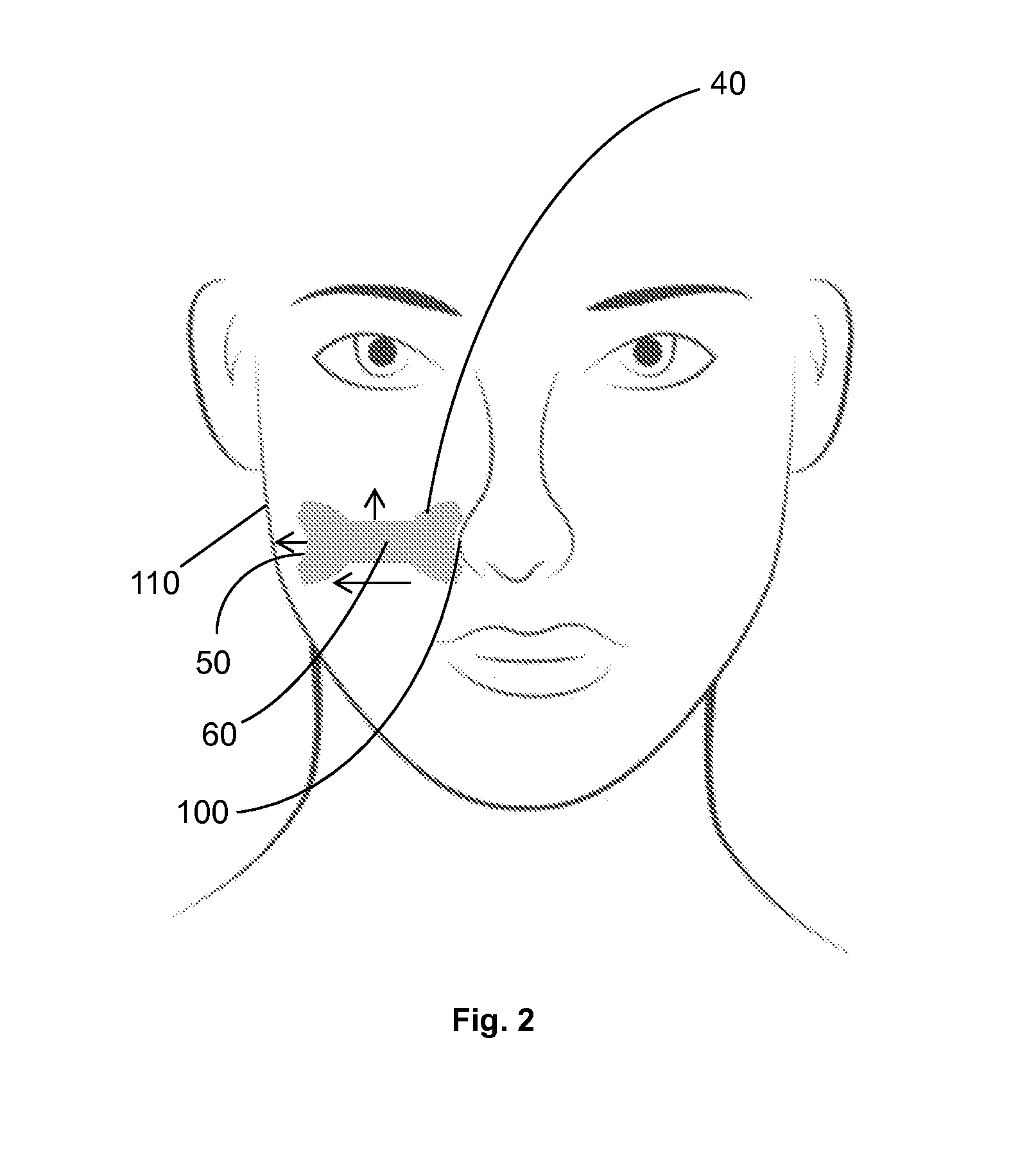 External nasal dilator and method of use