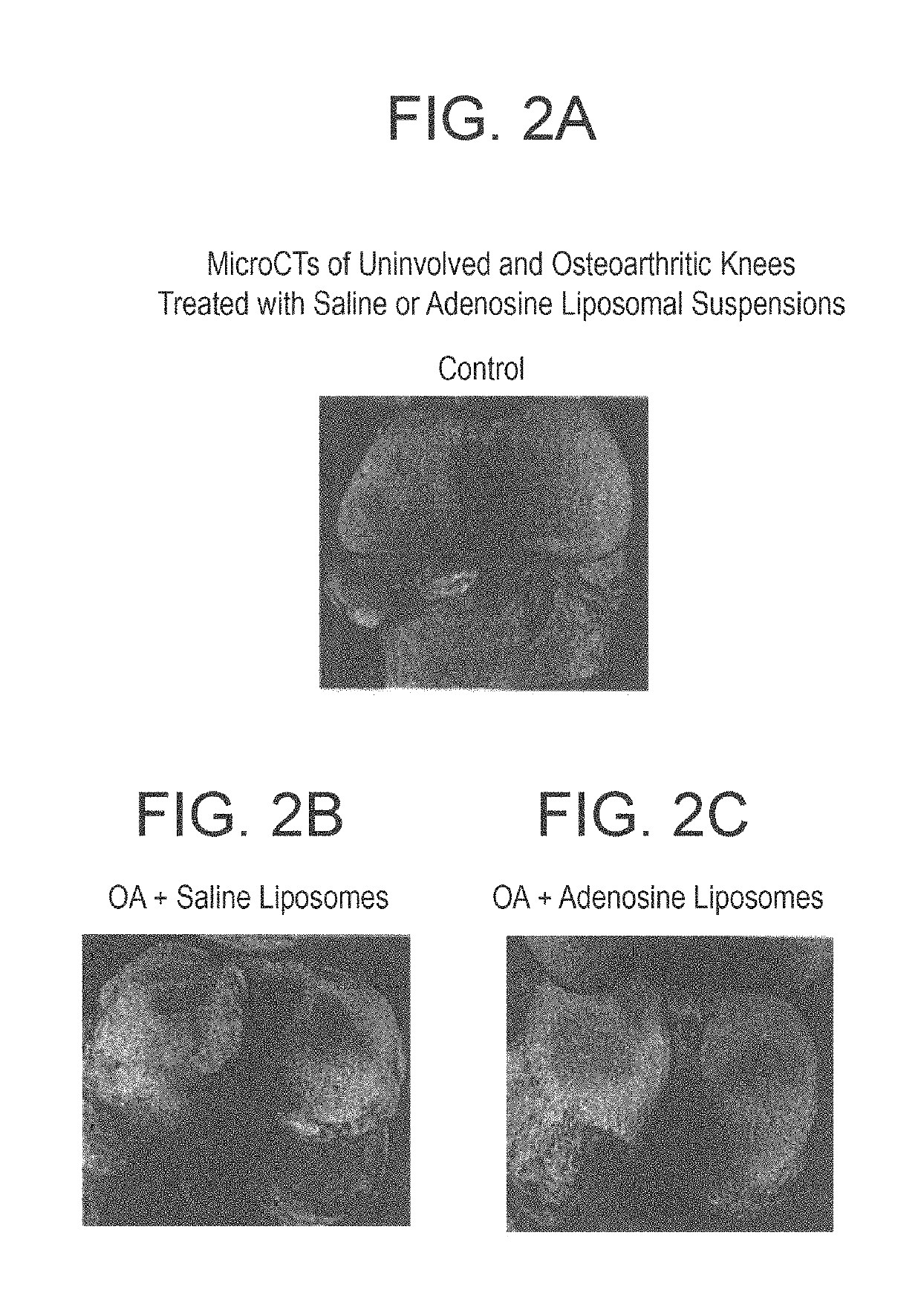 Methods and compositions for treating osteoarthritis and promoting cartilage formation