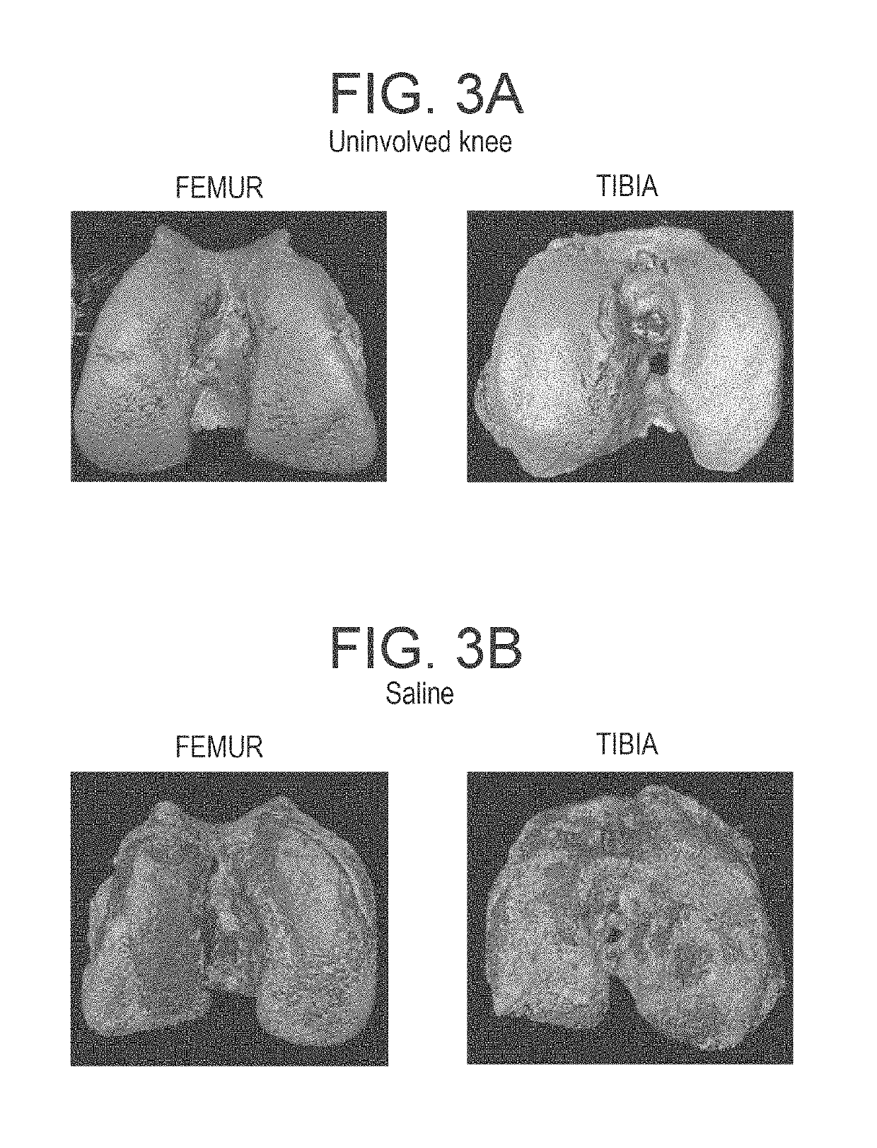 Methods and compositions for treating osteoarthritis and promoting cartilage formation