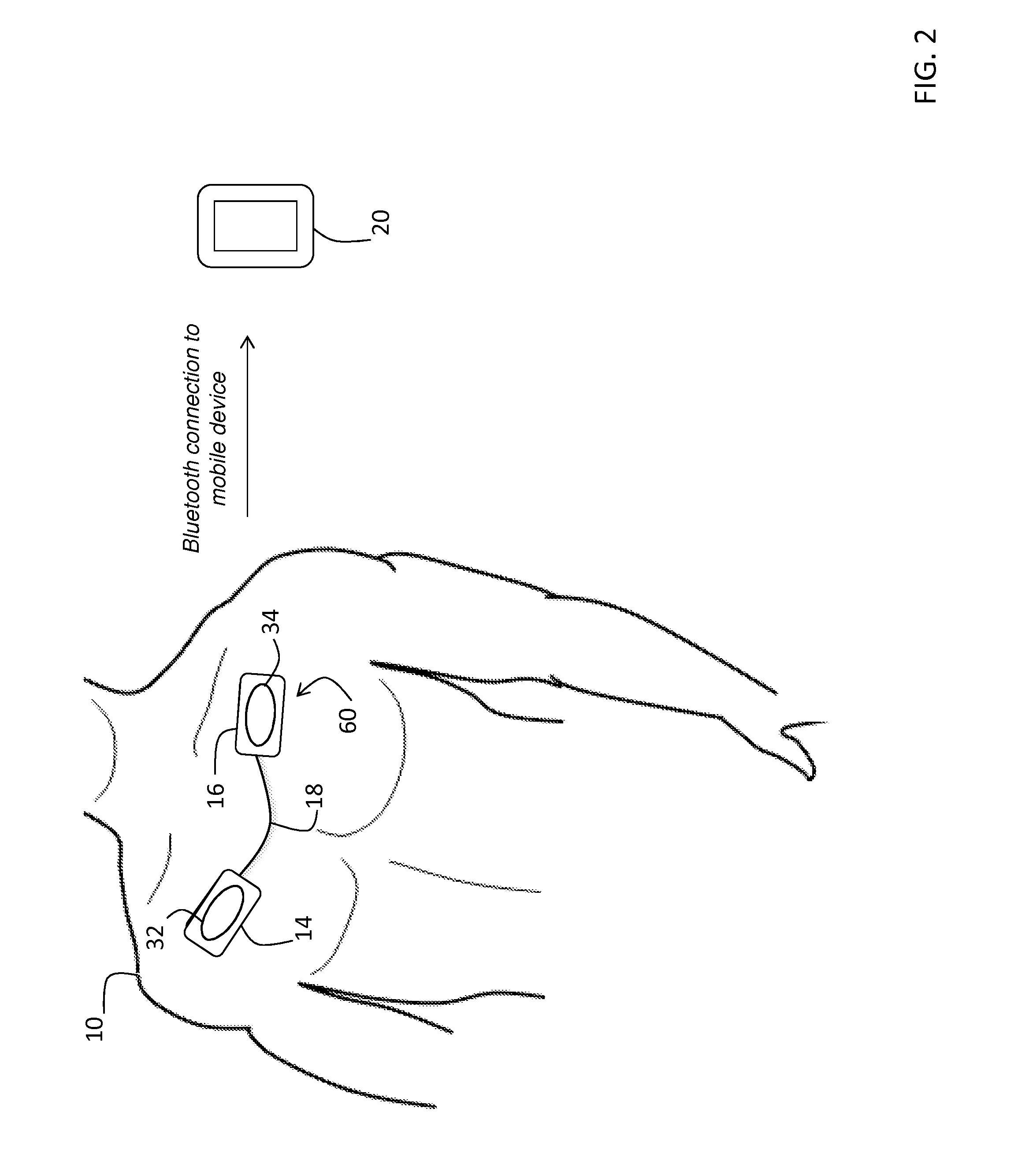 System for electrophysiology that includes software module and body-worn monitor