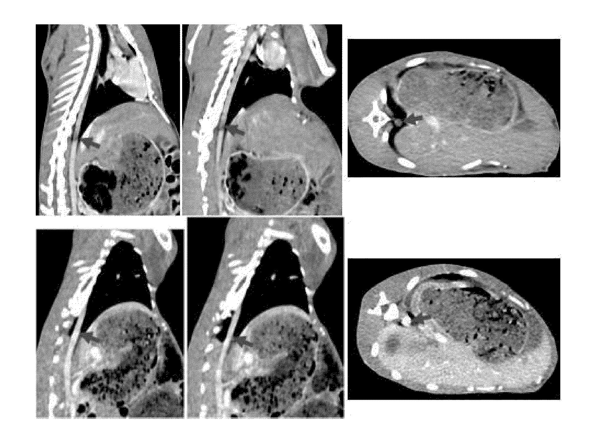 Series of drugs using photofrin to catalyze decomposition of hydrogen peroxide