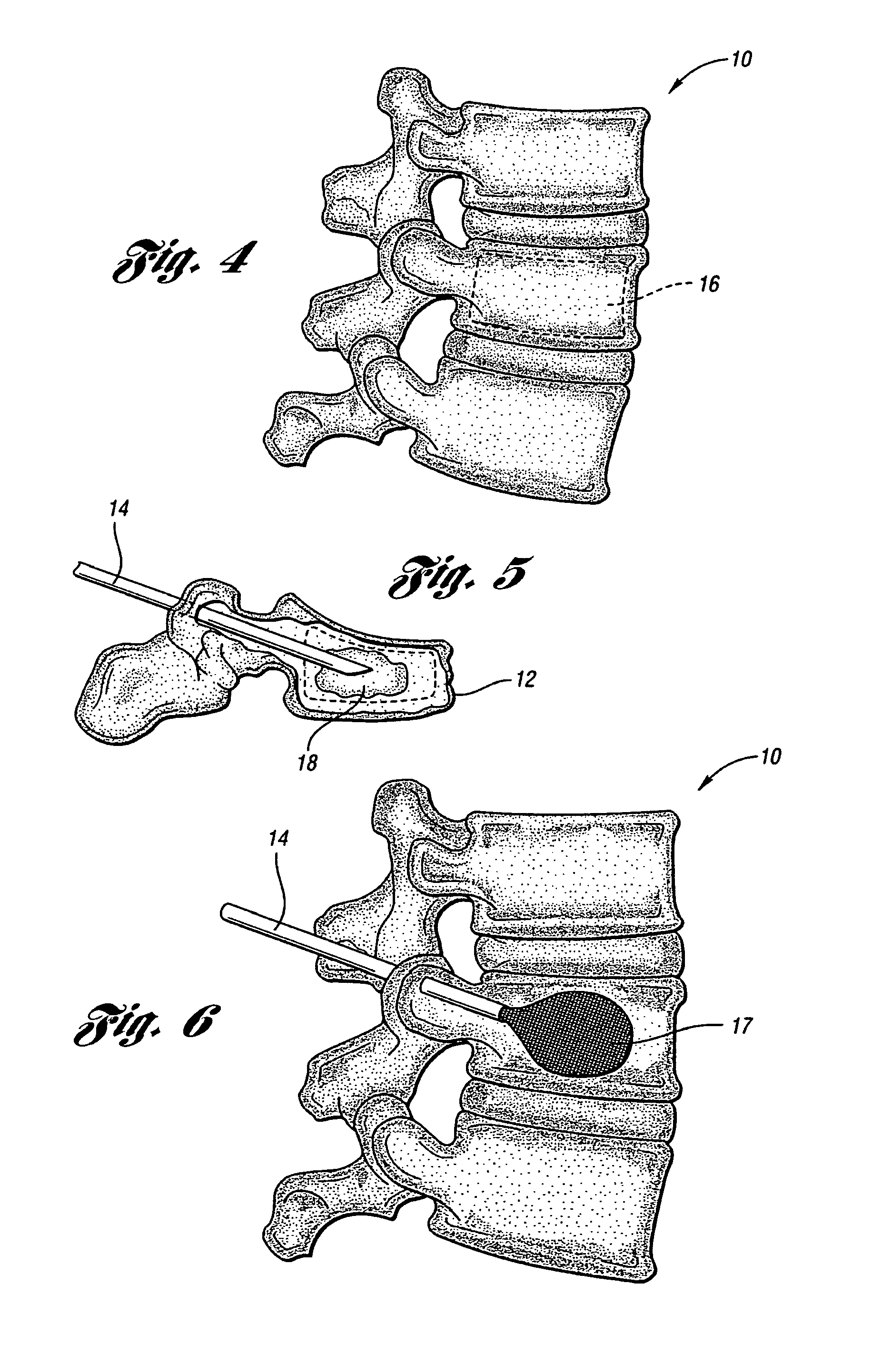 Vertebroplasty all in one mixer