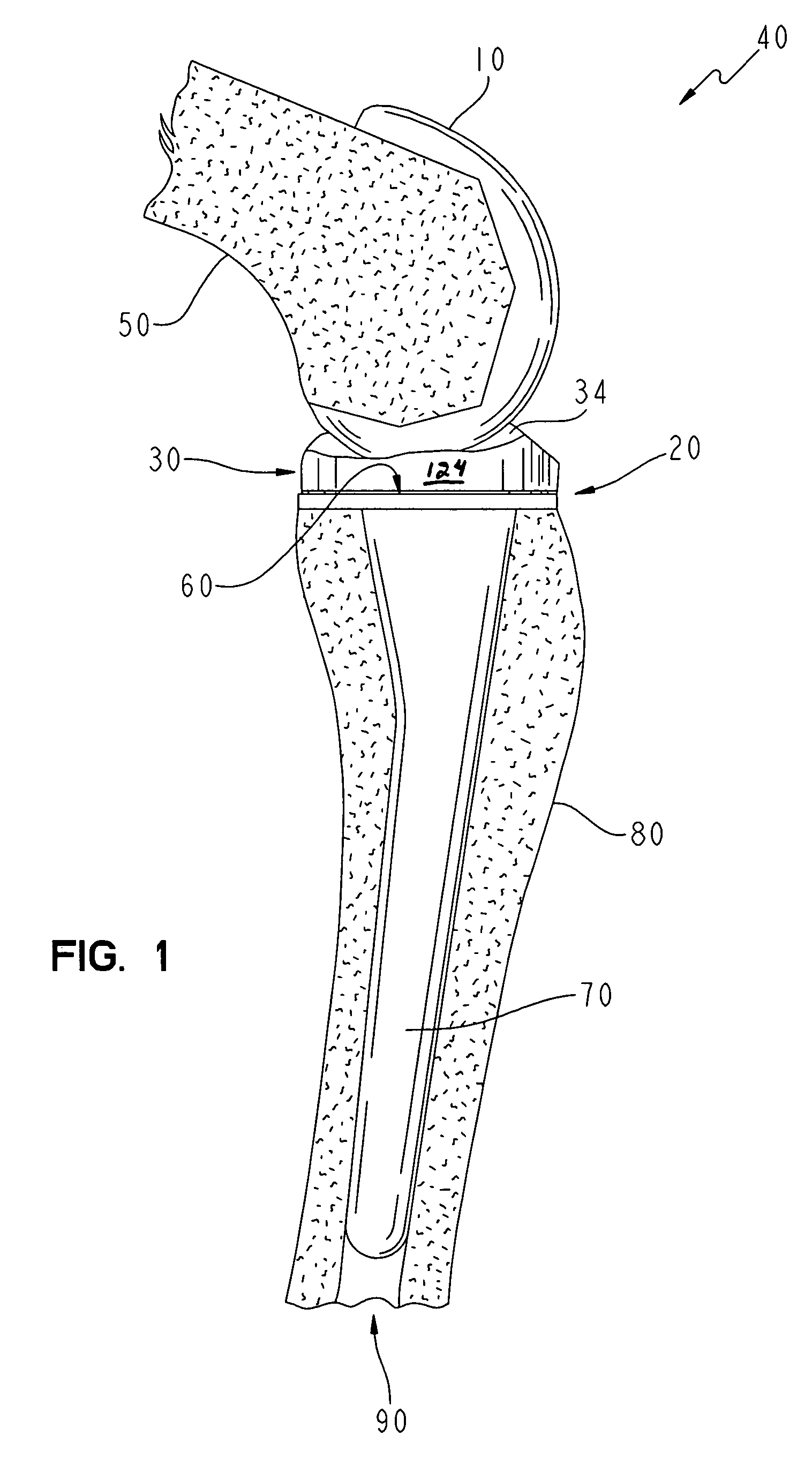 Modular implant with a micro-motion damper