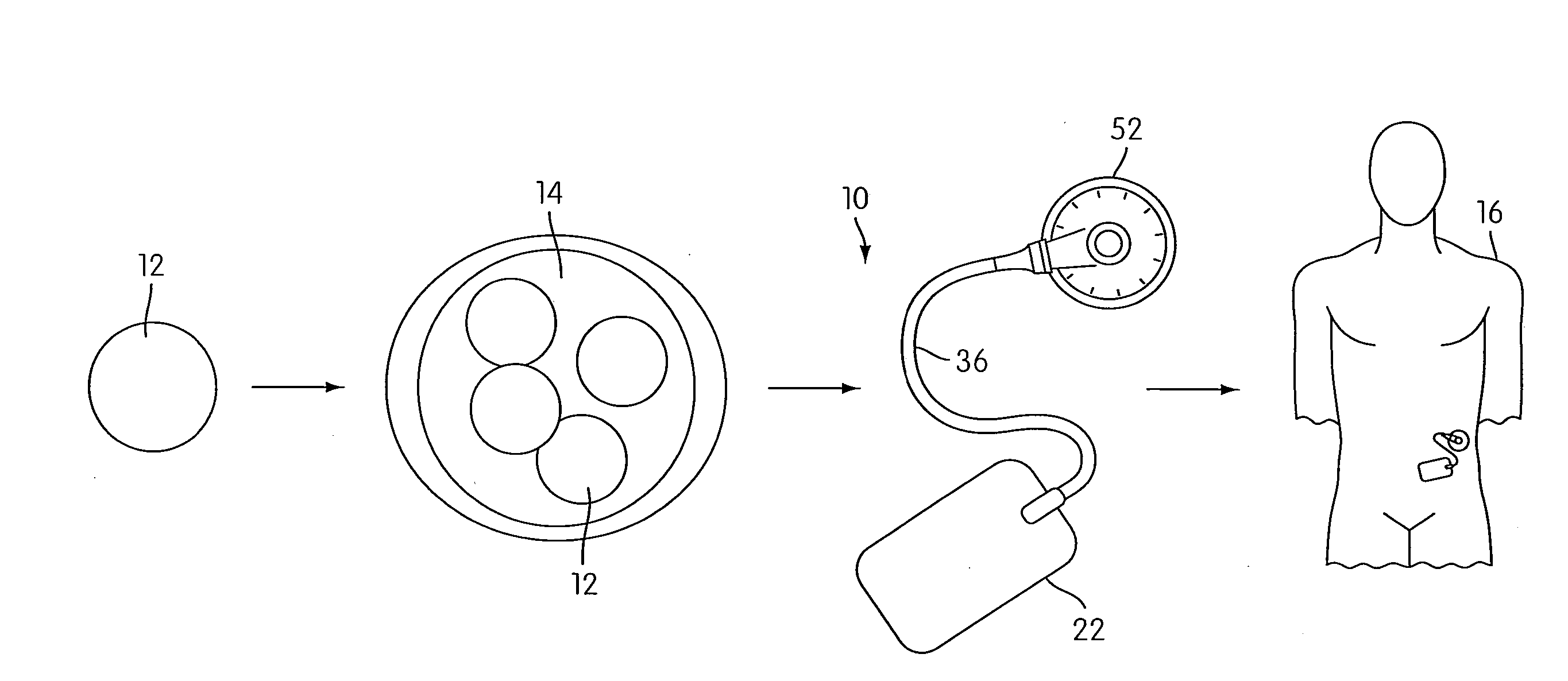 Angiogenesis Mechanism and Method, and Implantable Device