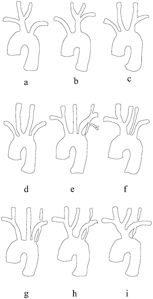 Multi-channel covered vascular stent and preparation method thereof