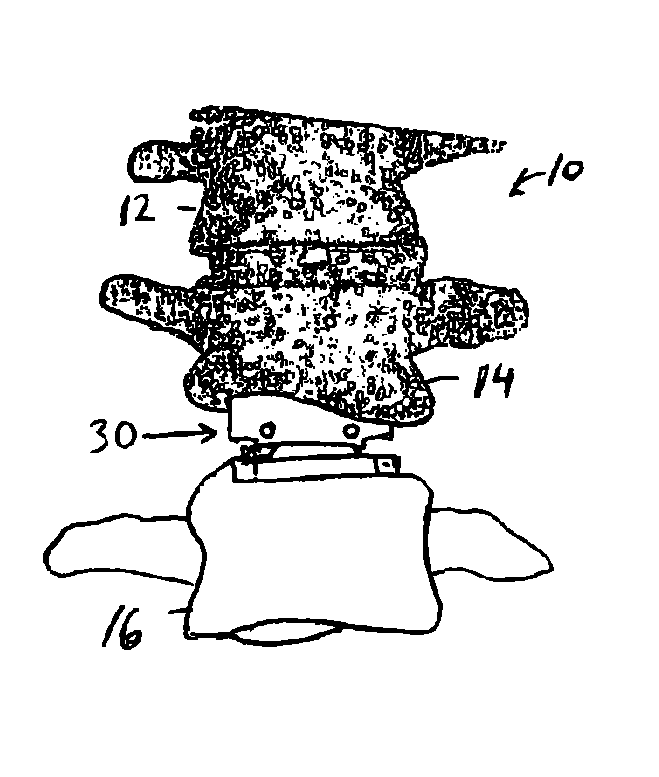 Customizing an intervertebral implant