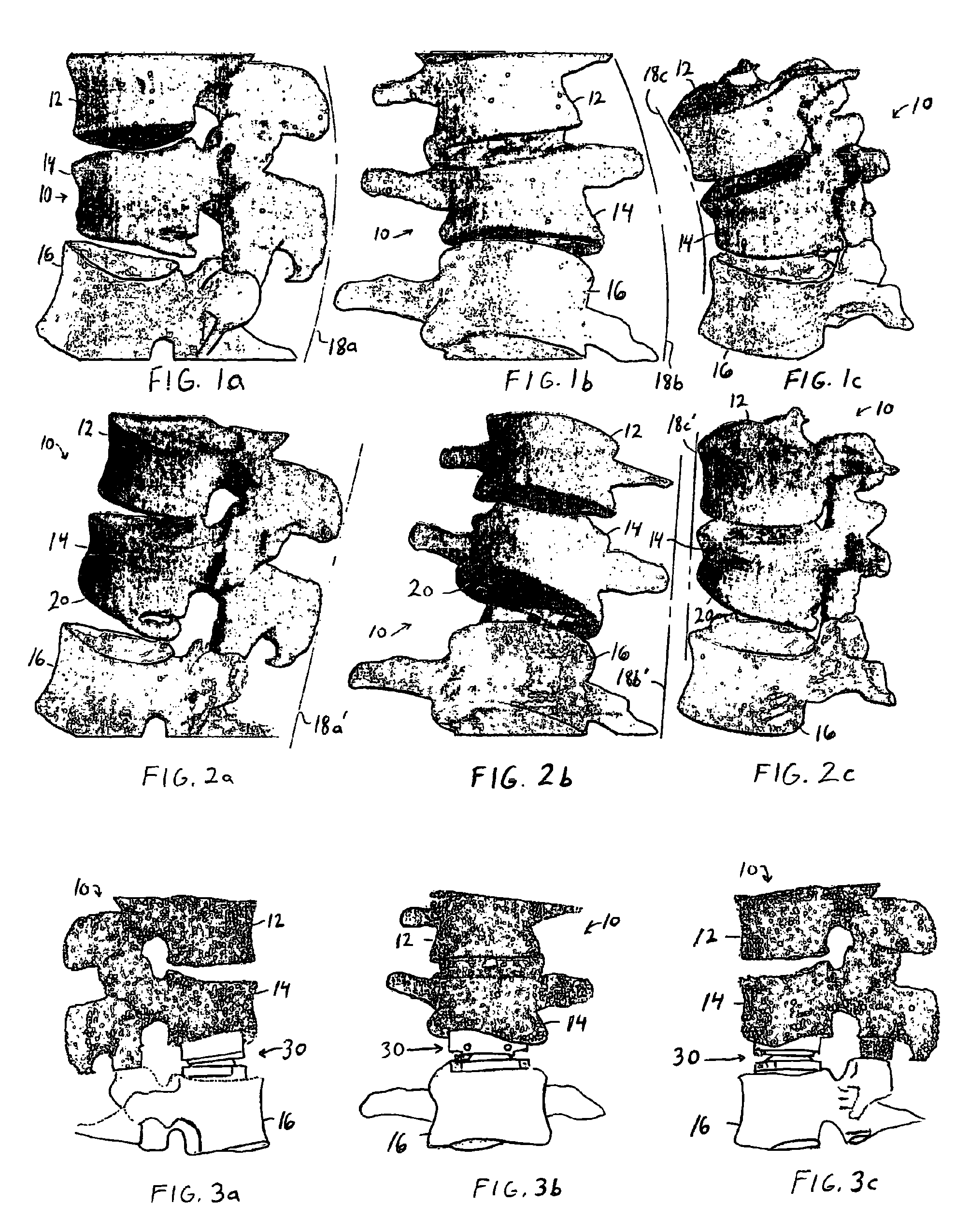 Customizing an intervertebral implant