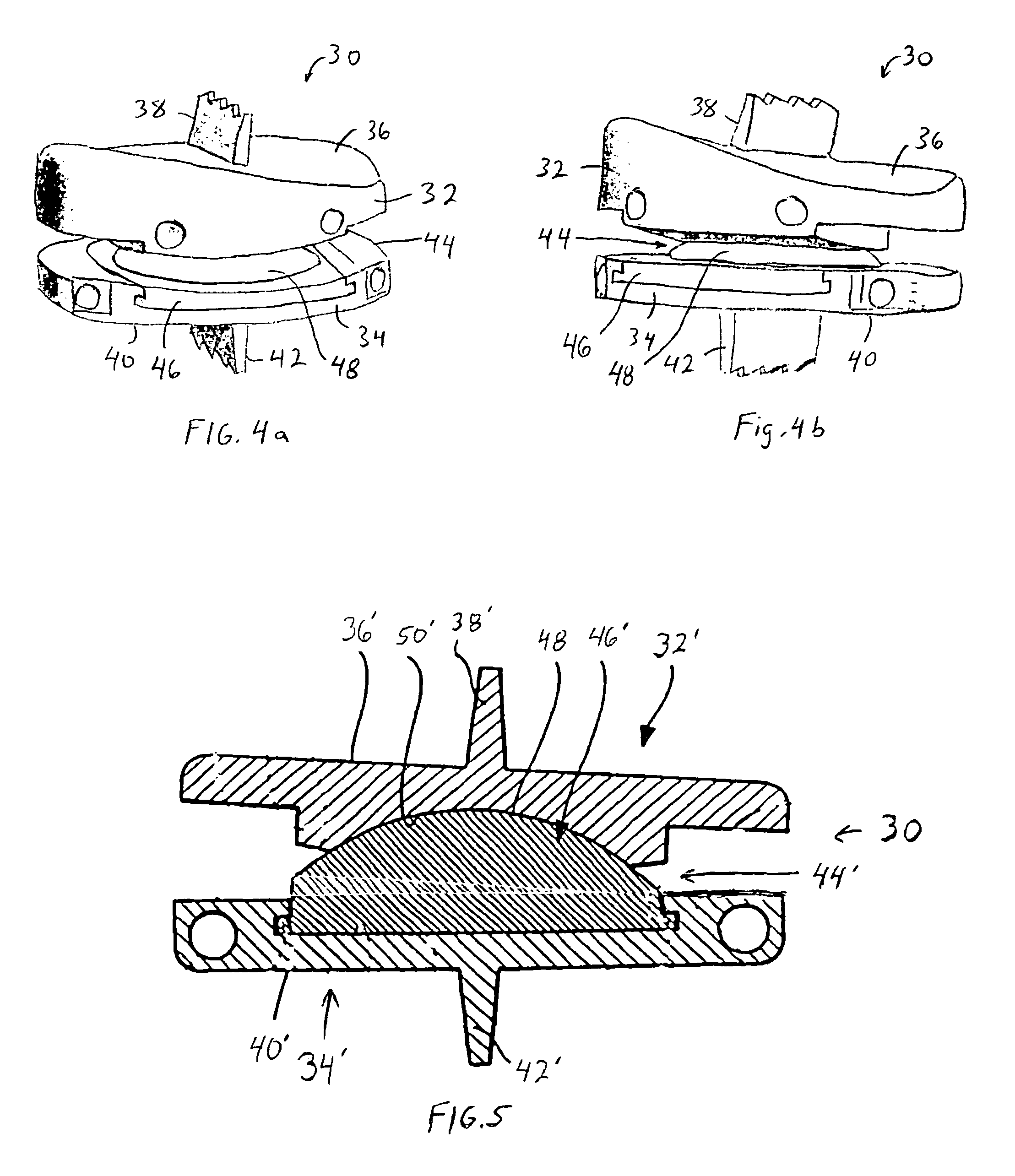 Customizing an intervertebral implant