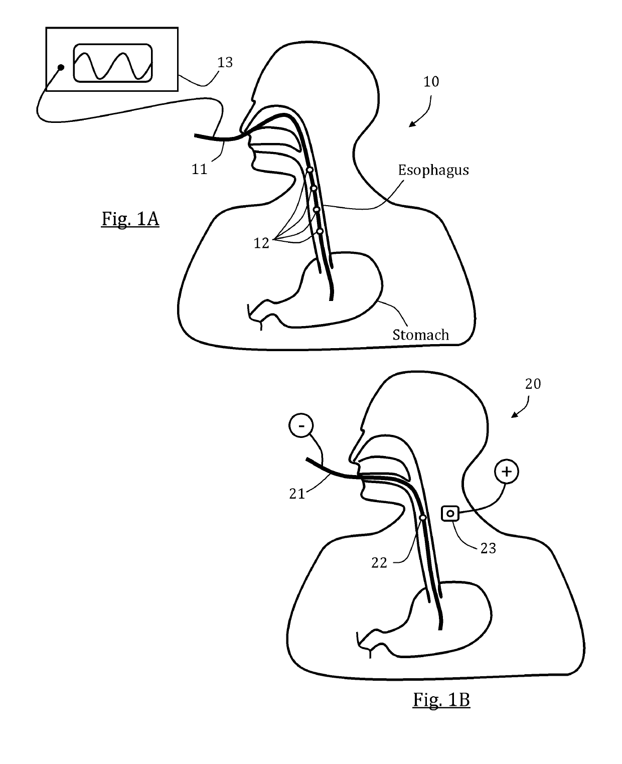 GI tract stimulation devices and methods