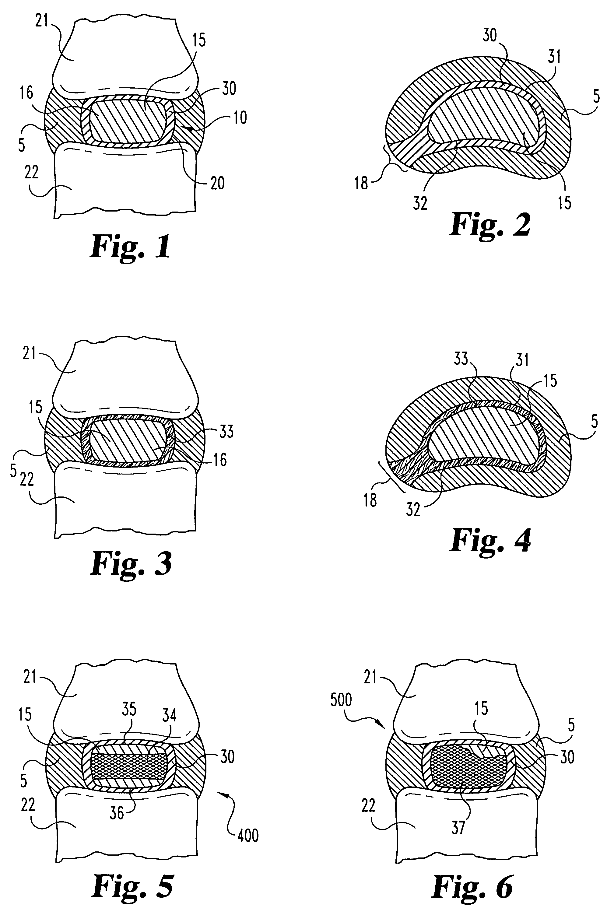 Composite intervertebral disc implants and methods for forming the same