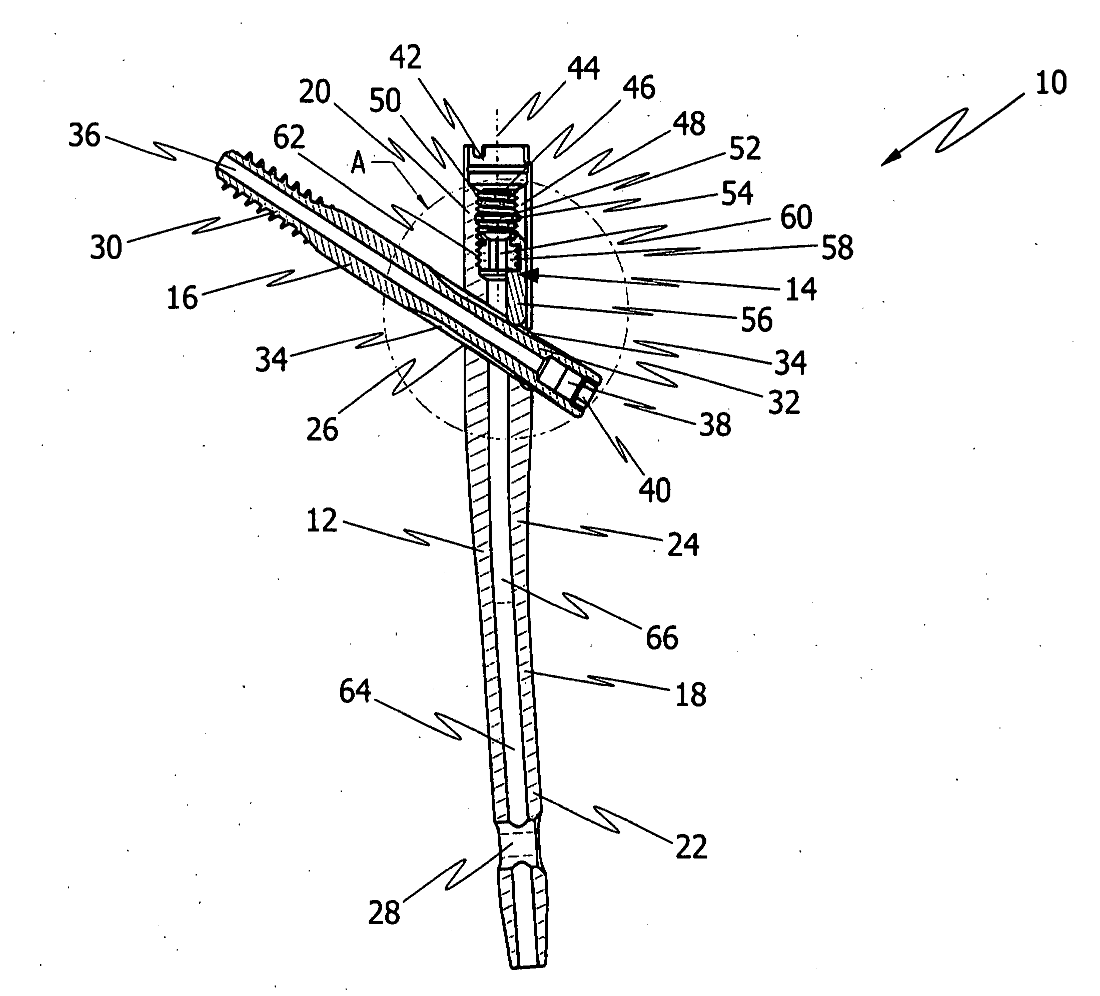 Implant system for bone fixation