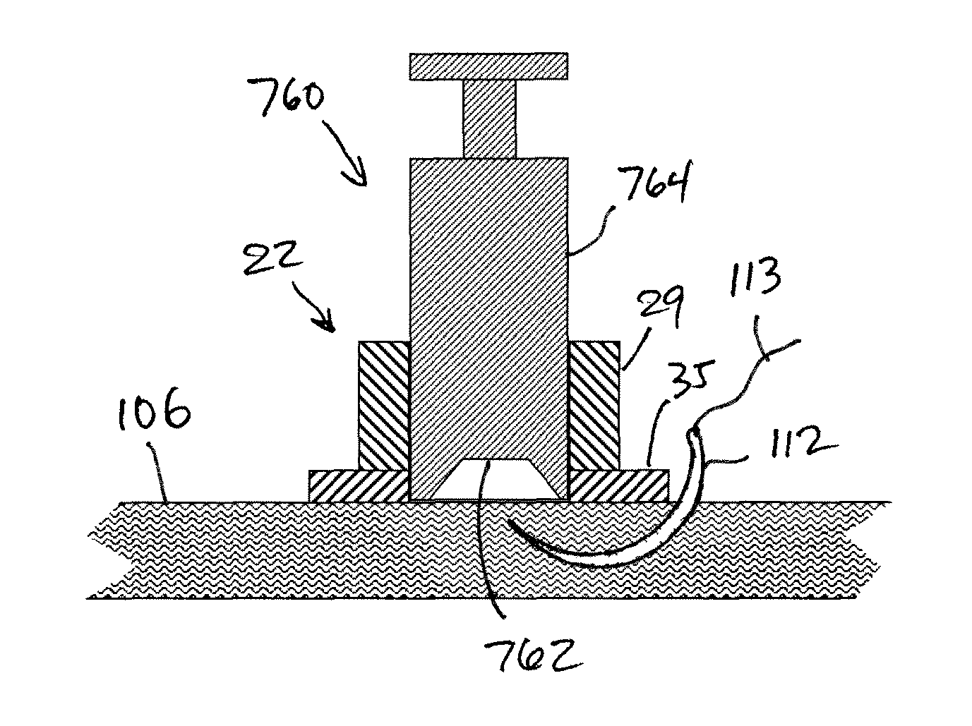 Assembly and method of implanting a heart assist system