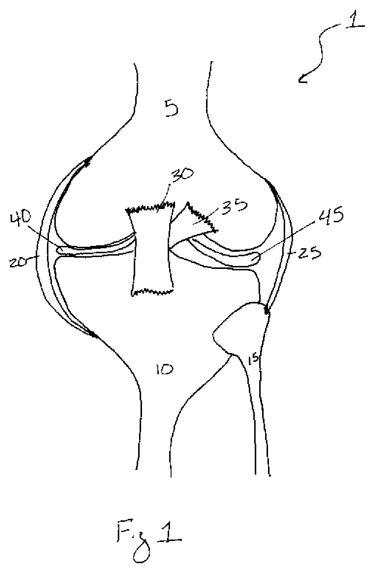 Methods of treating a trauma or disorder of the knee joint by local administration and sustained-delivery of a biological agent