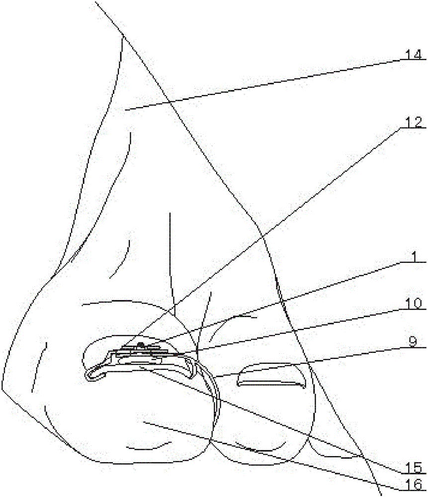 Single-sided corrective device for ingrown nail and operating method thereof