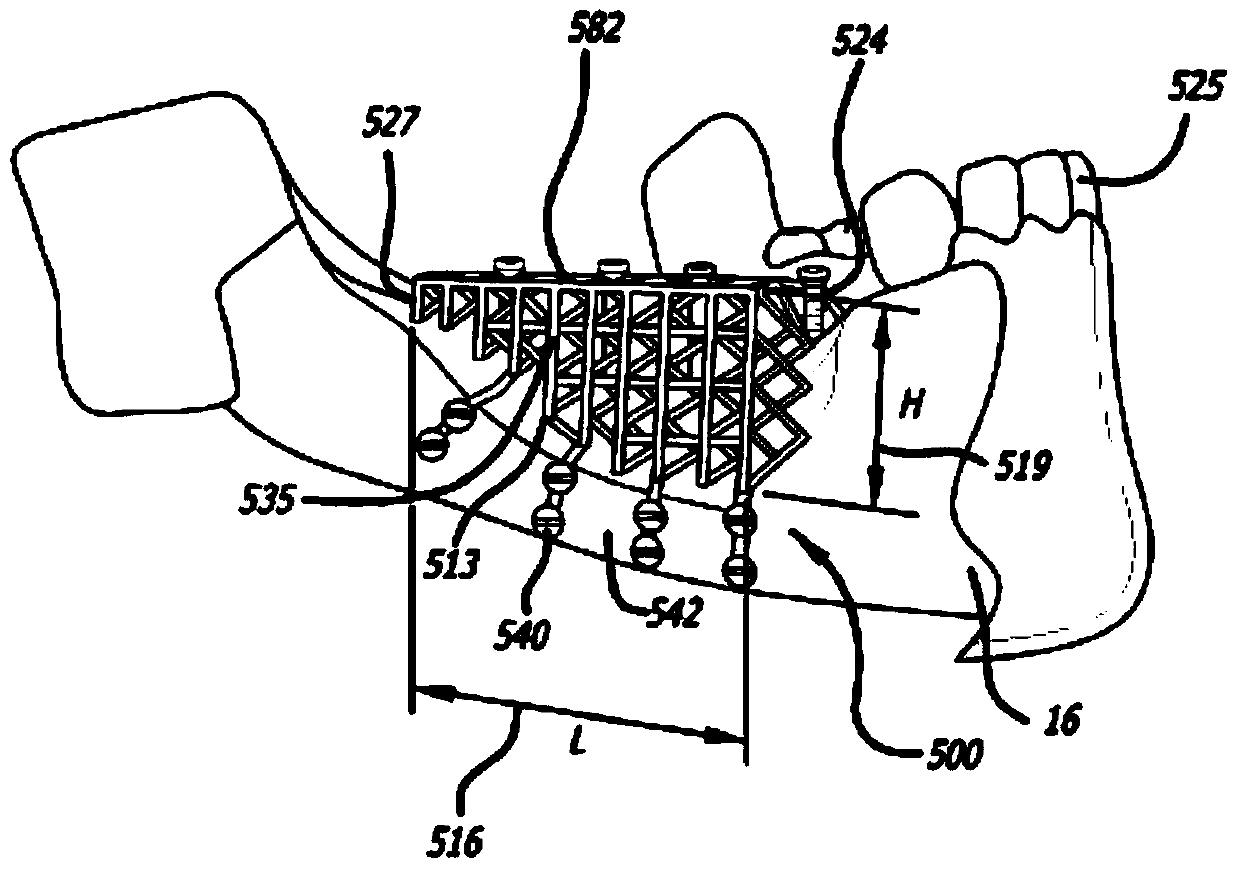 Devices and methods for enhancing bone growth