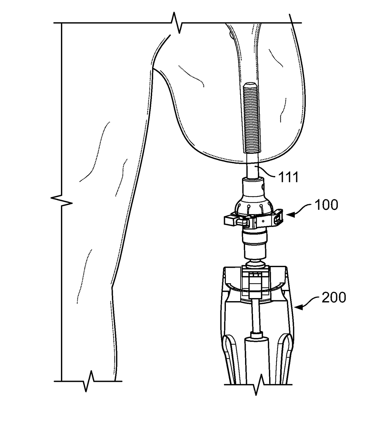 Safety Overload for Direct Skeletal Attachment