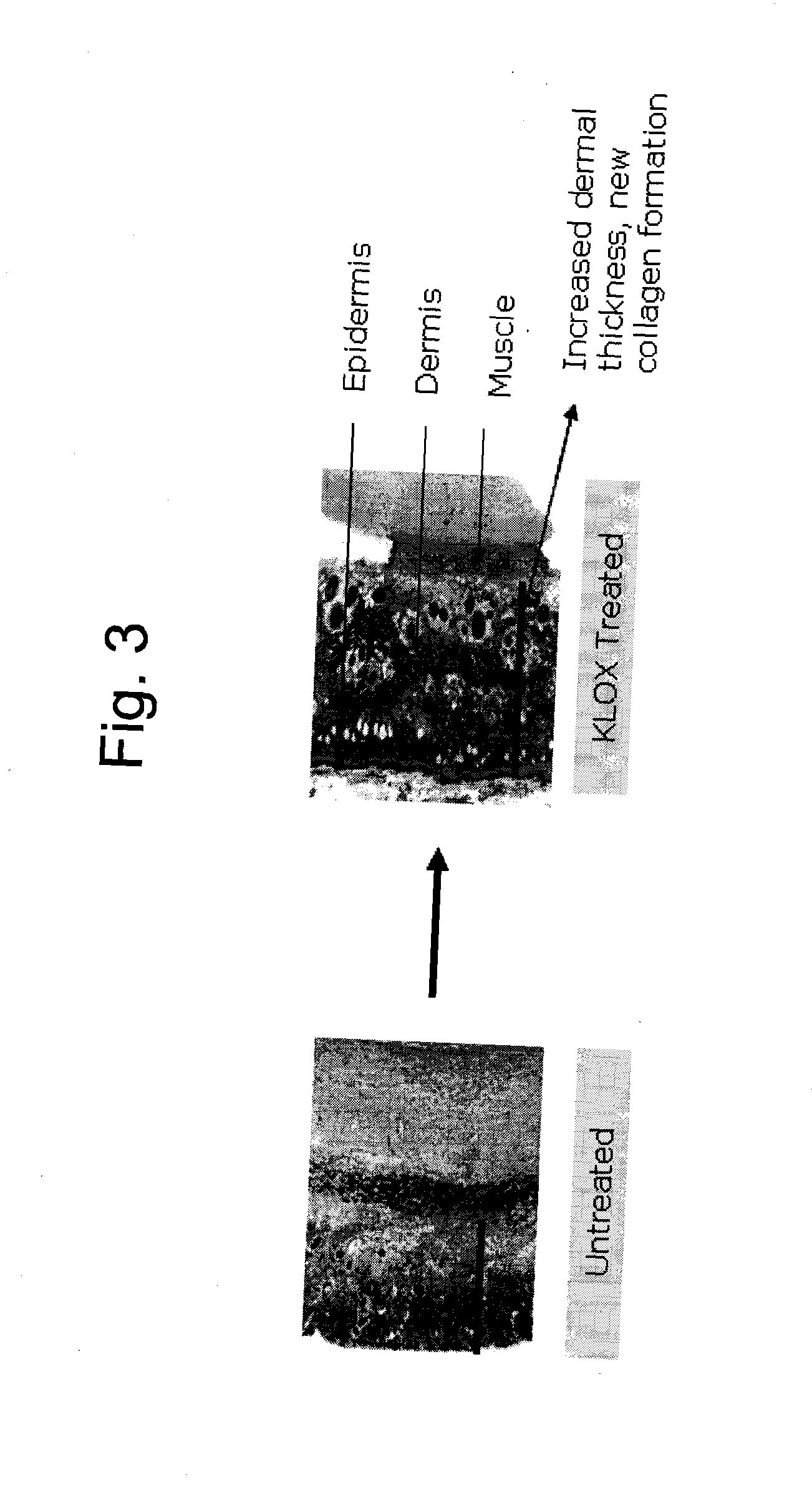 Oxidatitive photoactivated skin rejeuvenation composition comprising hyaluronic acid, glucosamine, or allantoin