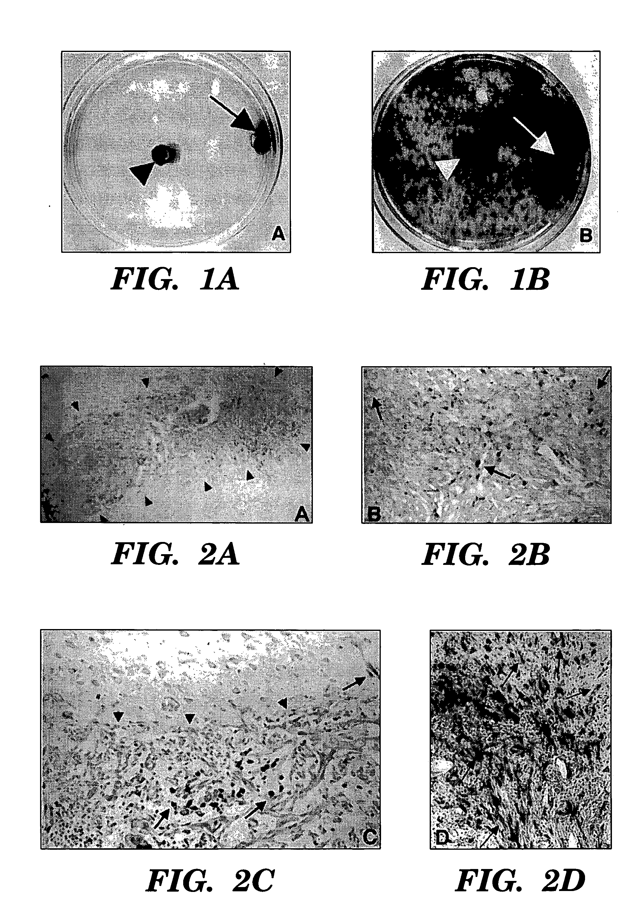 Engraftable neural progenitor and stem cells for brain tumor therapy